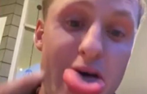 Dok je jeo hamburger, PČELA ga ubola u JEZIK: Evo kako sad izgleda i priča (VIDEO)