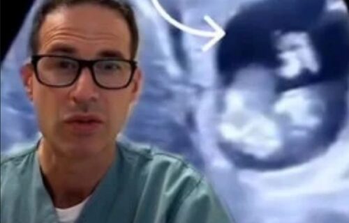 Lekar pogledao u ekran i ZANEMEO od šoka: Neverovatno šta je ženi ZALUTALO u jetru (VIDEO)