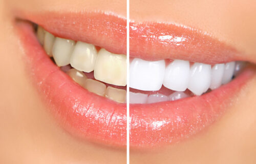 Proverite u čemu grešite: Šest razloga zbog kojih zubi postaju ŽUTI, i kako da to sprečite