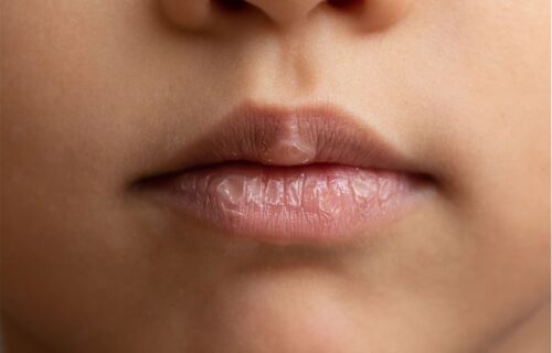 Imate problem sa ispucalim usnama? Pet prirodnih rešenja će vam sigurno pomoći
