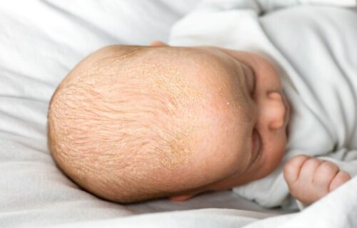 Temenjača kod beba: Javlja se u vidu LJUSPICA na koži glave, a evo kada treba da posetite PEDIJATRA
