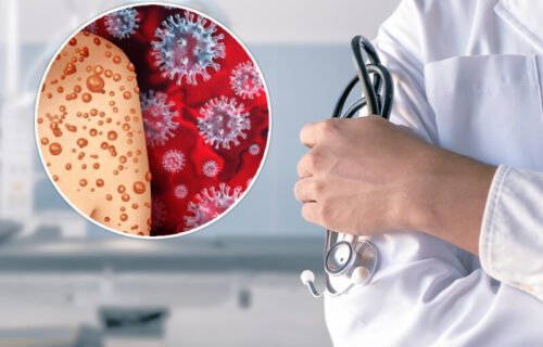 Sve o novoj pošasti o kojoj bruji svet: Evo koji su simptomi MAJMUNSKIH BOGINJA i šta je prevencija