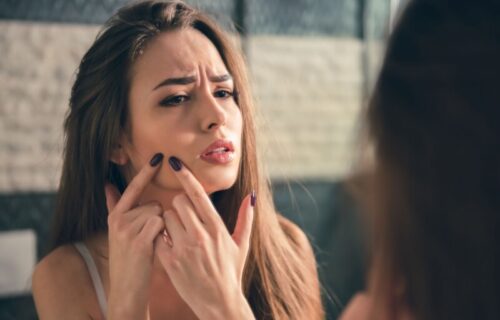 Poslušajte savete DERMATOLOGA: Kako da pravilno istisnete bubuljicu, a da vam ne ostane OŽILJAK?