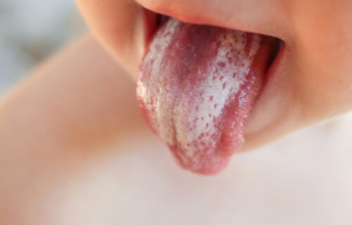Uporna GLJIVIČNA infekcija: Zašto se javlja SOR u bebinim ustima, kako da ga uklonite i da li je opasan?