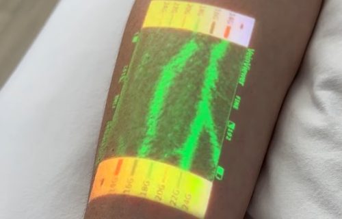 Vađenje krvi nikada nije bilo lakše: Uz infracrvene zrake, lakše do vene (VIDEO)