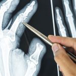 Neverovatno otkriće: Lepak za kosti, umesto metalnih poluga