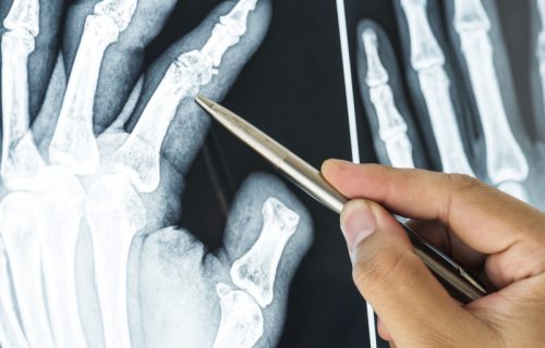 Neverovatno otkriće: Lepak za kosti, umesto metalnih poluga