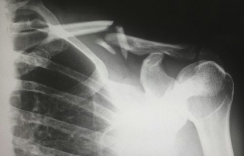Neverovatno otkriće: Lepak za kosti, umesto metalnih poluga