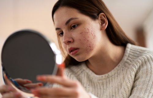 Imate problem sa aknama? Ne pojavljuju se bez razloga, a mesto na kojem su otkriva vaše loše navike