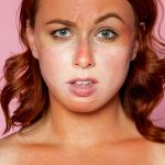 Izgoreli ste na suncu? Dermatolozi otkrivaju šta odmah treba da uradite