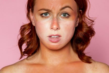 Izgoreli ste na suncu? Dermatolozi otkrivaju šta odmah treba da uradite