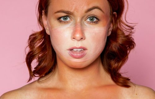 Izgoreli ste na suncu? Dermatolozi otkrivaju šta odmah treba da uradite