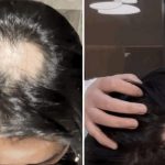 Idu pod nož zbog "plastične glave": Novi "beauty trend" zahteva rizično preoblikovanje lobanje