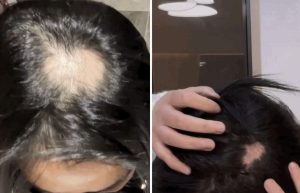Idu pod nož zbog “plastične glave”: Novi “beauty trend” zahteva rizično preoblikovanje lobanje
