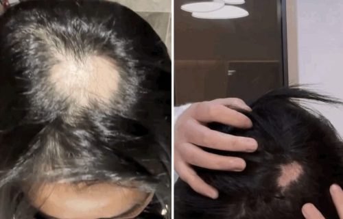 Idu pod nož zbog "plastične glave": Novi "beauty trend" zahteva rizično preoblikovanje lobanje