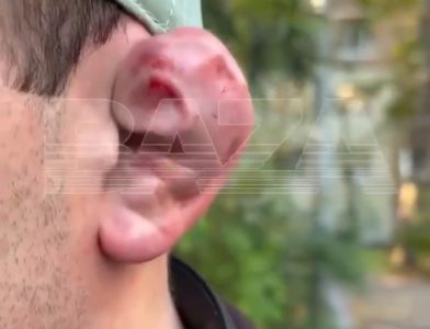 Bizaran trend među mladićima: Sakate sebi uši da bi “dominirali”, lekari apeluju na jezive povrede