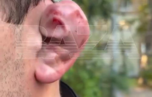 Bizaran trend među mladićima: Sakate sebi uši da bi "dominirali", lekari apeluju na jezive povrede