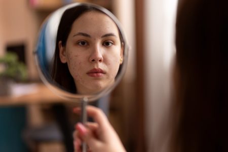 Dermatolozi otkrivaju trik za pronalaženje uzroka akni: Pogledajte gde se pojavljuju na licu