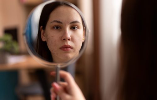 Dermatolozi otkrivaju trik za pronalaženje uzroka akni: Pogledajte gde se pojavljuju na licu