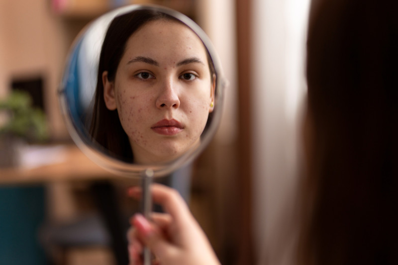 Dermatolozi otkrivaju trik za pronalaženje uzroka akni: Pogledajte gde se pojavljuju na licu
