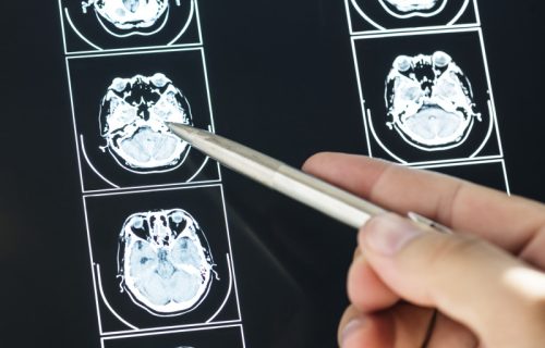 Um koji se ne gasi: Zašto je mozak iscrpljen i kada nije reč o “previše obaveza“